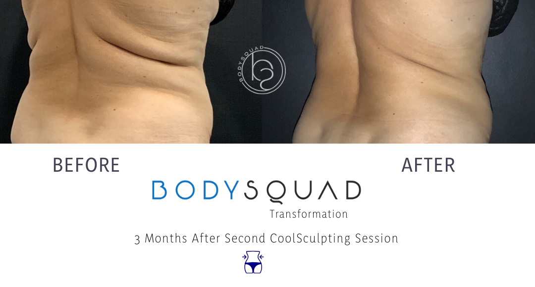 Before and after BodySquad transformation with CoolSculpting melted the fat away for this patient in Boca Raton