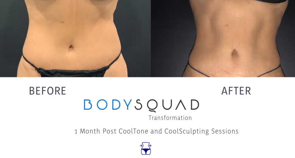 Before and after BodySquad transformation with CoolSculpting and CoolTone combined to give this patient a bikini body in South Florida