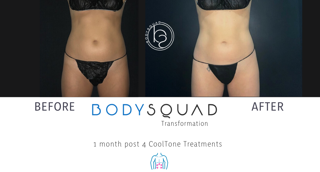 before and after photo of 25-year-old woman tone her abdomen for increased definition with CoolTone at BodySquad Boca Raton
