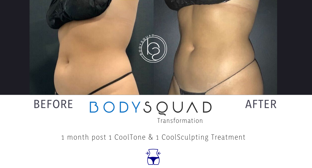 Transformation of the Week: Tone and Taut Tummy With CoolSculpting - The  Body Squad