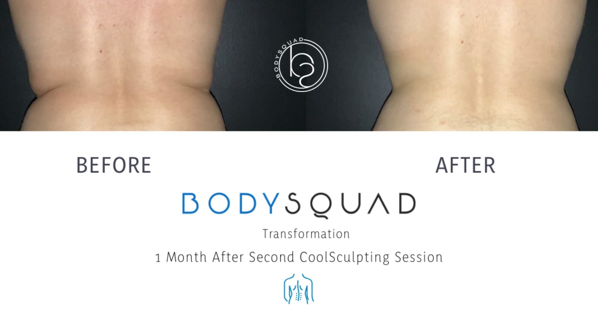 CoolSculpting back treatment before and after at the BodySquad Boca Raton