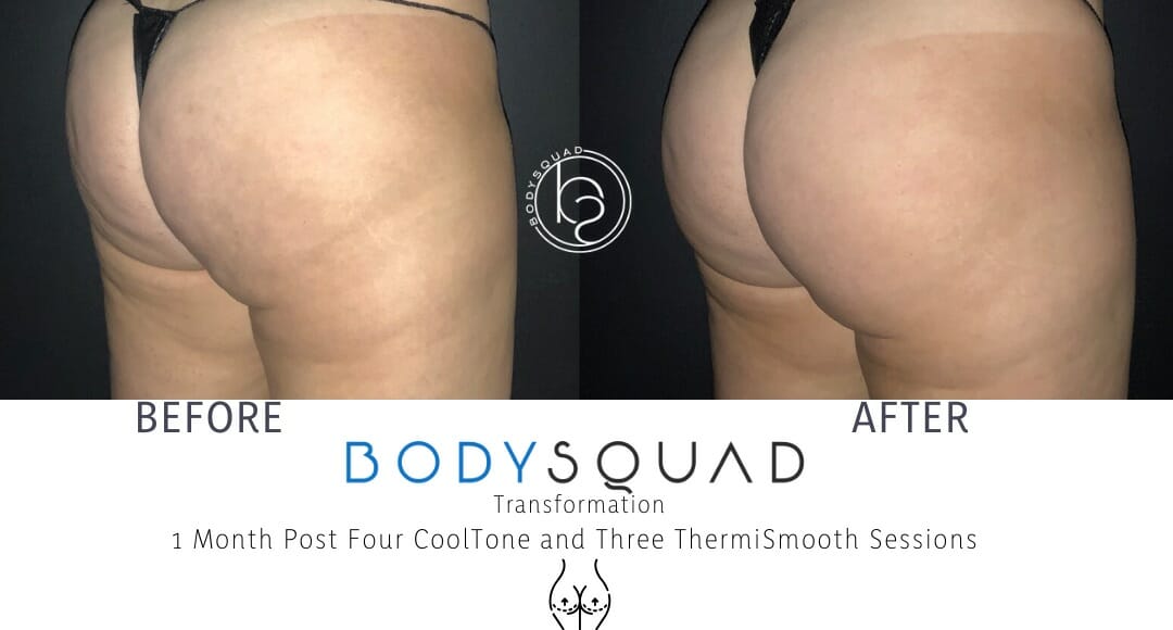 CoolSculpting booty treatment before and after at the BodySquad Boca Raton