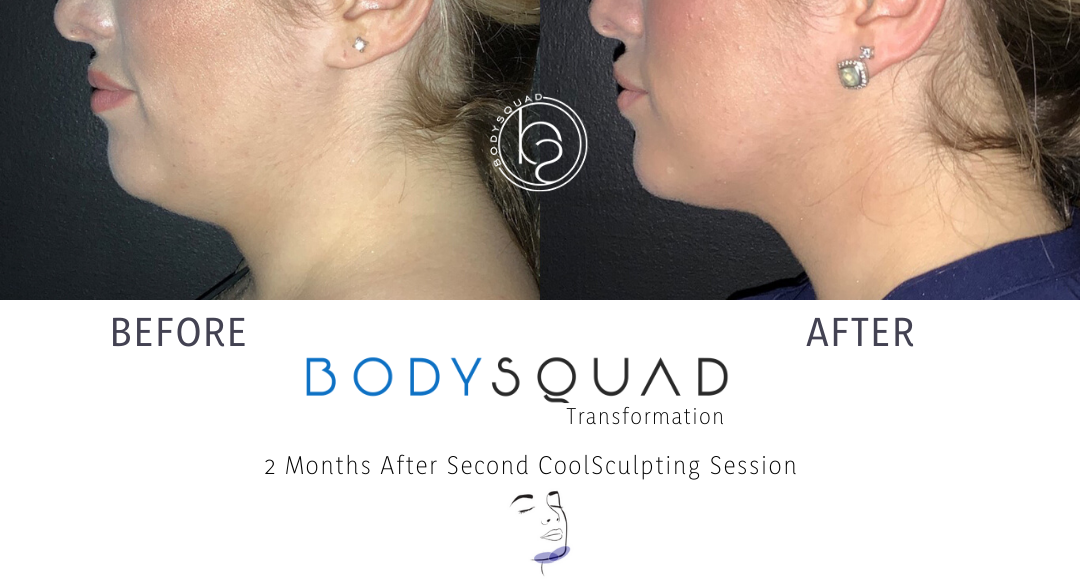 CoolSculpting chin treatment before and after side profile view at the BodySquad Boca Raton