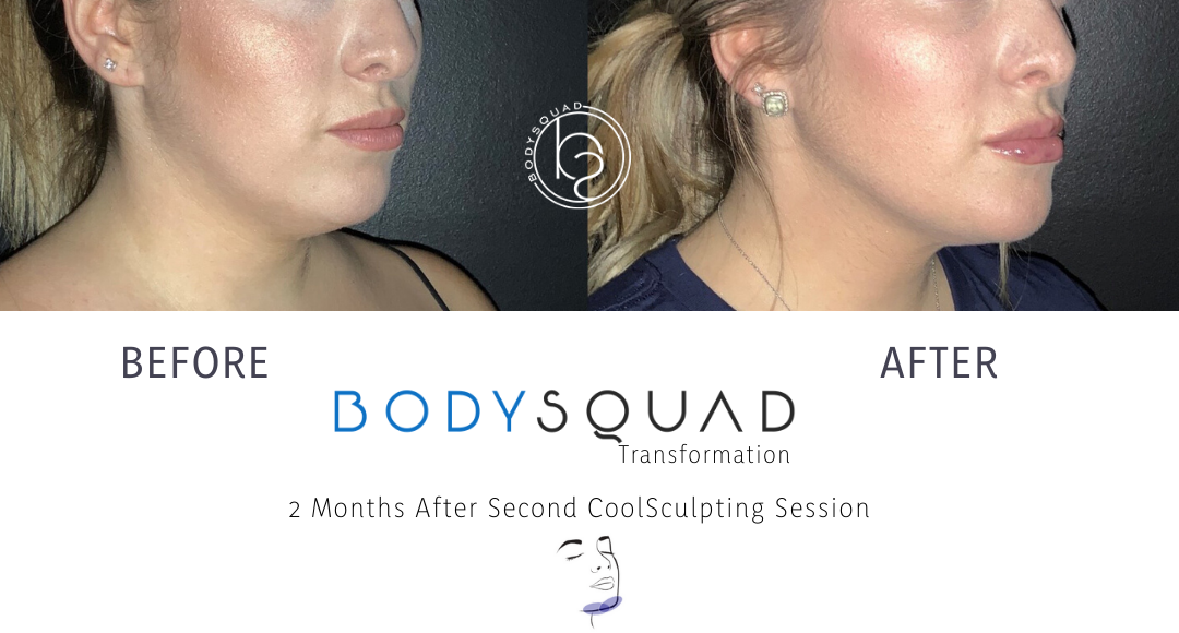 CoolSculpting chin treatment before and after at the BodySquad South Florida