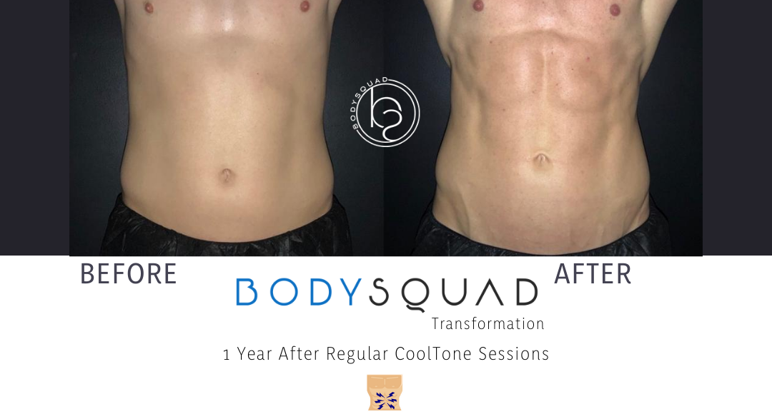 CoolTone before and after front view results after 1 year of treatments at BodySquad Boca Raton