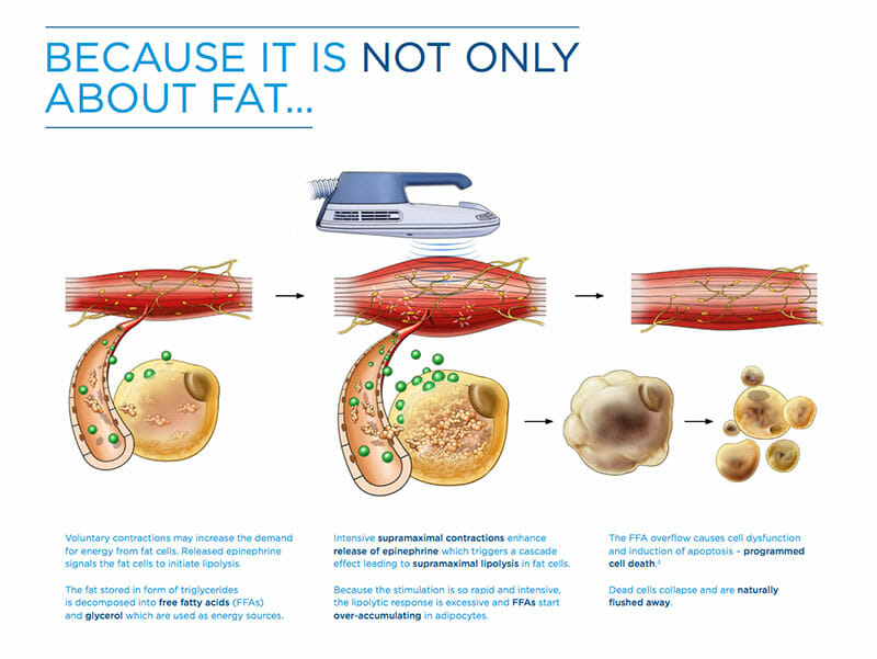 An graphic that demonstrates CoolSculpting