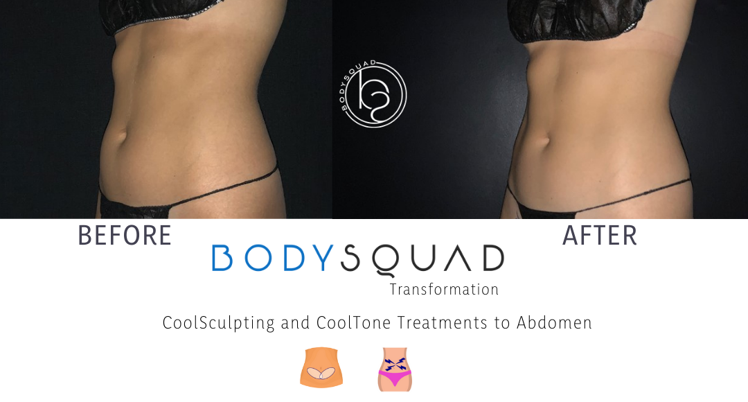 CoolSculpting and CoolTone on the abdomen side view before and after photos from the BodySquad