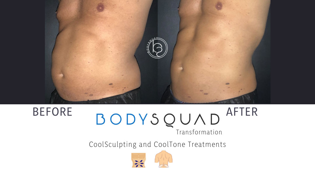 dad bod beer belly transformation to a 6-pack reducing fat and building muscle with CoolSculpting and CoolTone at BodySquad Boca Raton Florida