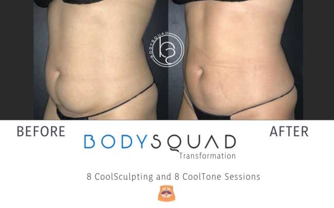 Before & After photo of a stomach after 8 CoolSculpting and 8 CoolTone sessions at BodySquad