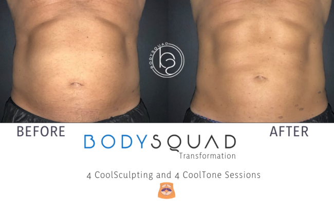 Before & After photo of a stomach after 4 CoolSculpting and 4 CoolTone sessions at BodySquad
