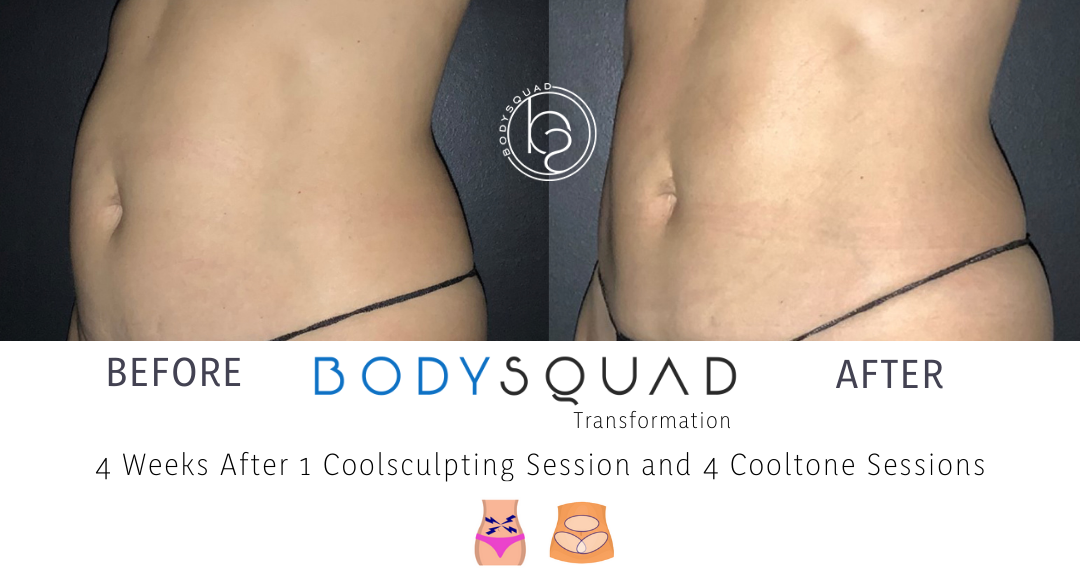 coolsculpting Archives - The Body Squad