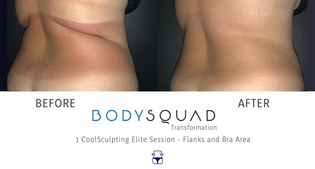 before and after results from targeting the back from coolsculpting elite at bodysquad