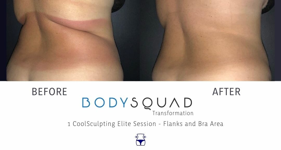 Two CoolSculpting® sessions on the flanks helped this patient achieve his  goals of reducing stubborn fat on his love handles. Individual…