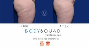 RESONIC for cellulite reduction on the booty and thighs at BodySquad Boca Raton