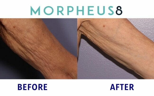 morpheus8 skin tightening treatment