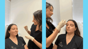 Botox Injections